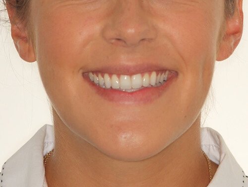 Orthognathic Surgery After