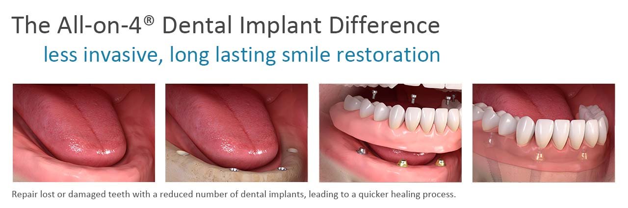 Removable Implant-Supported Denture Solutions