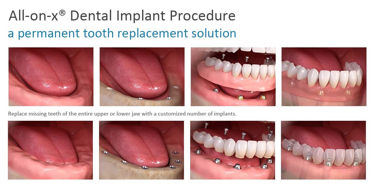 Removable Implant-Supported Denture Solutions