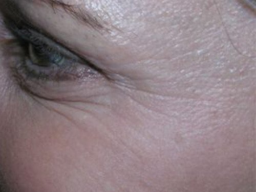 Botox® Cosmetic Injections After