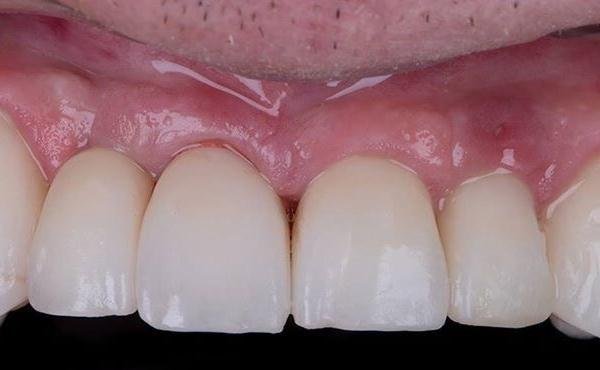 Replacing Single Tooth After