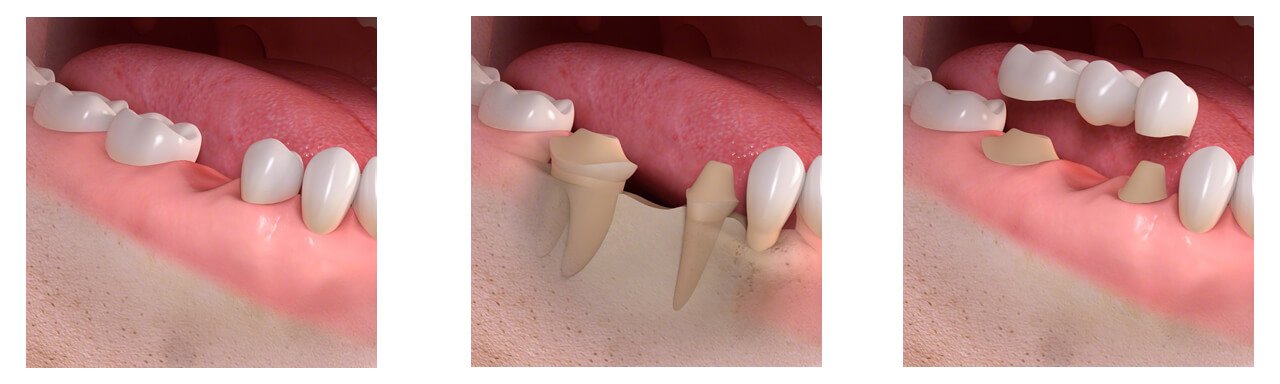 Dental Implant Procedure